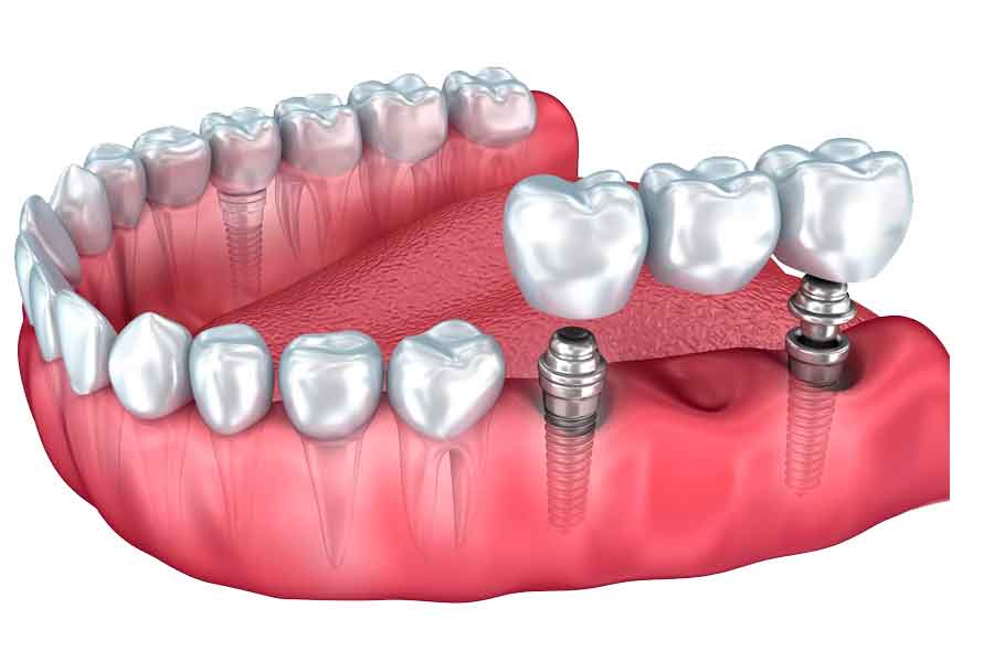 Современные технологии в стоматологии: протезирование, имплантация и отбеливание Современные технологии в стоматологии: протезирование, имплантация и отбеливание
